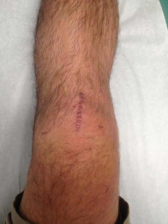 acl surgery scar